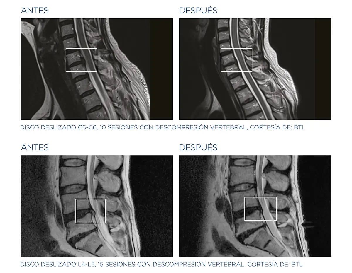 descompresion-de-columna-vertebral-madrid-radiografias